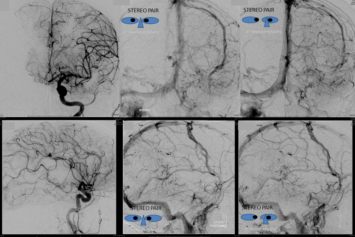 Venous infarct dural fistula