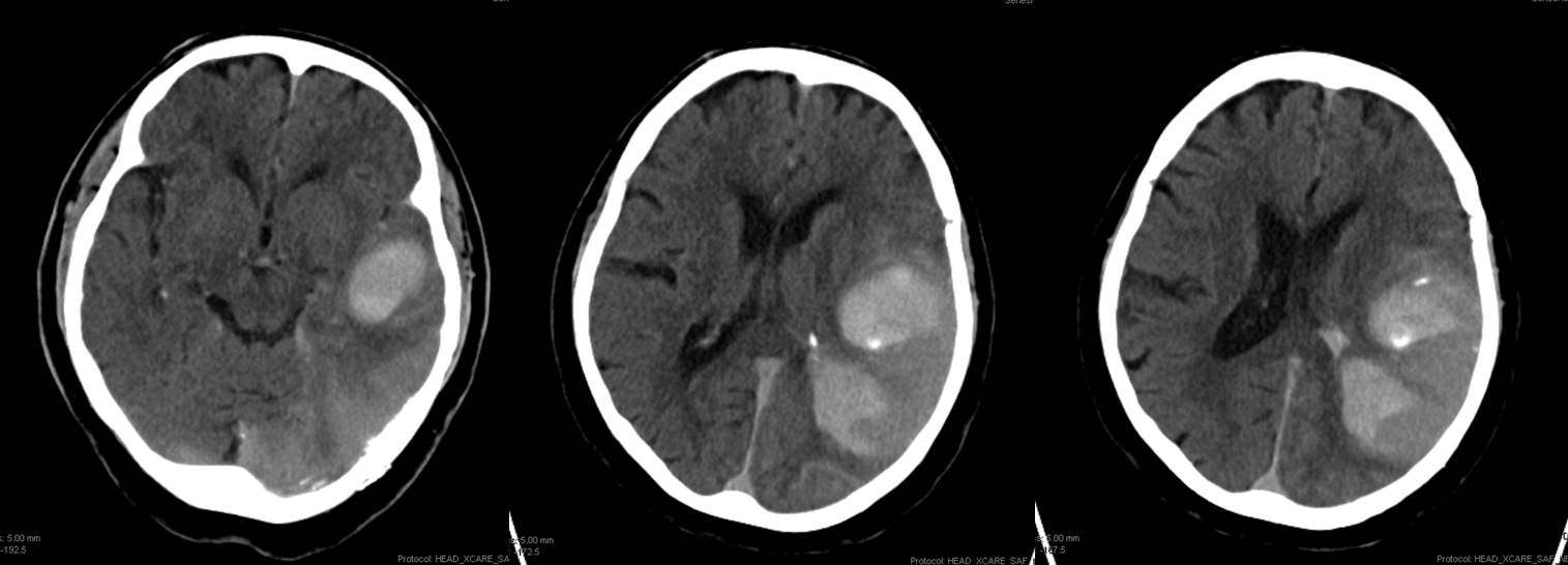 Case Archives Sigmoid Sinus Dural Fistula with Extensive Venous