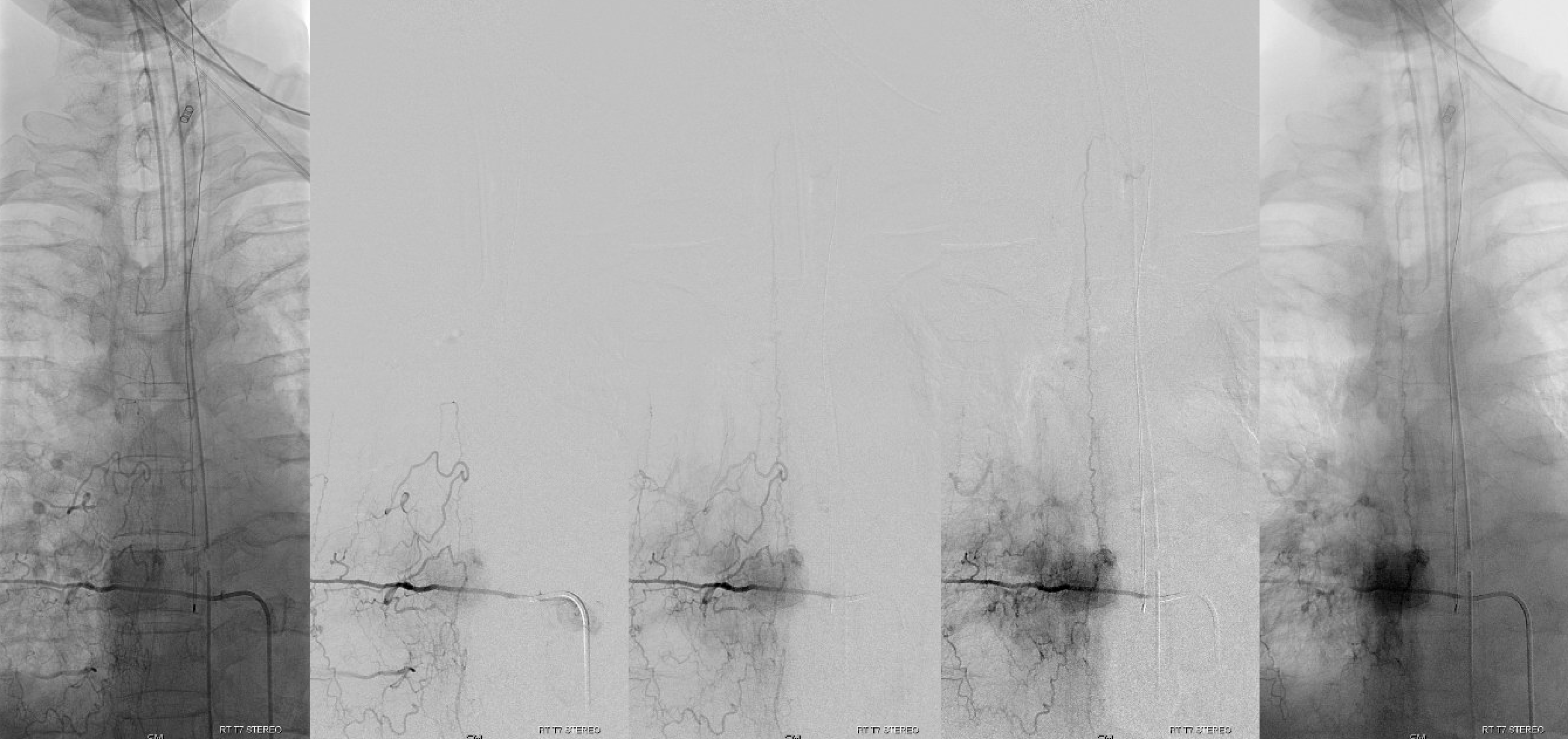Spinal Vascular Anatomy Neuroangio Org