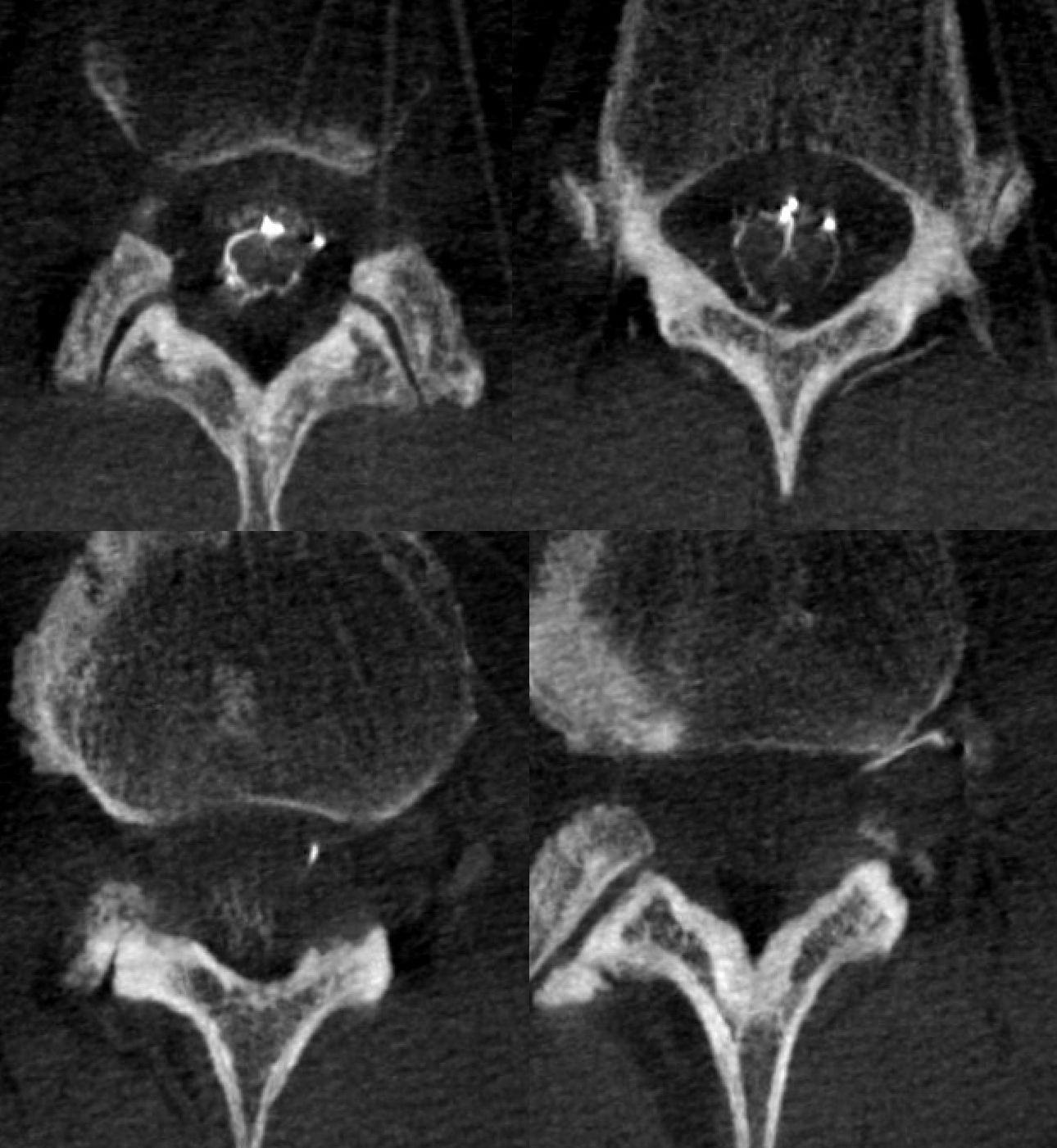 Pdf Upper Cervical Intramedullary Schwannoma Of The Spinal Cord