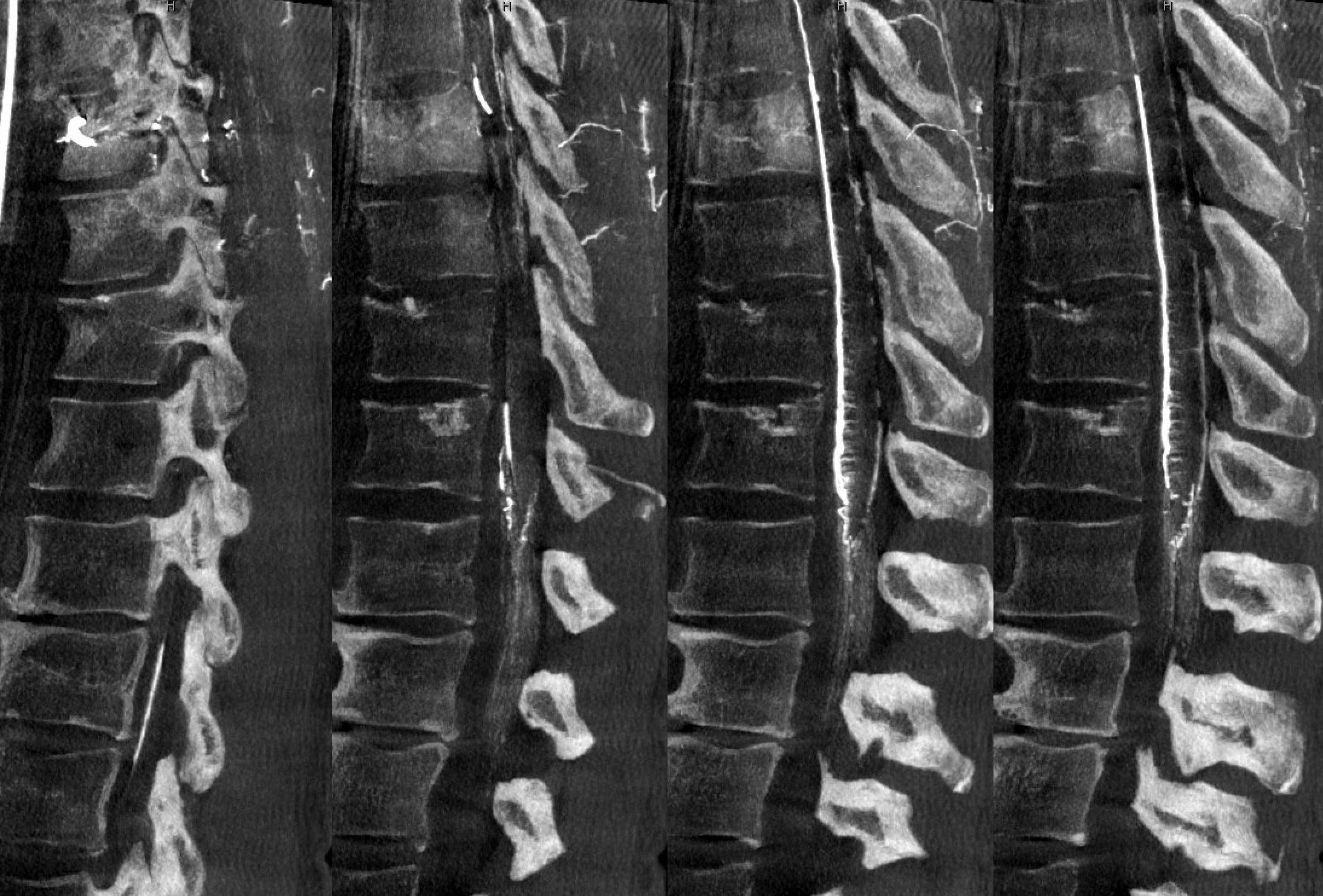 Pdf Upper Cervical Intramedullary Schwannoma Of The Spinal Cord