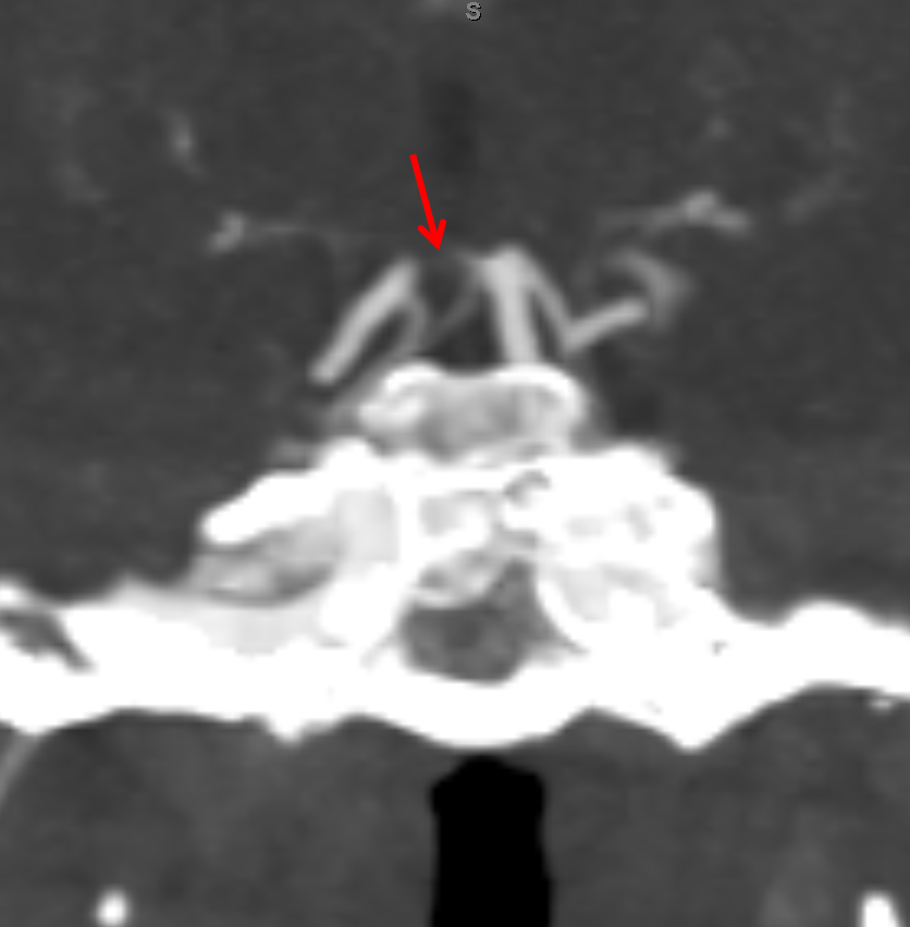 Artery of Percheron Occlusion