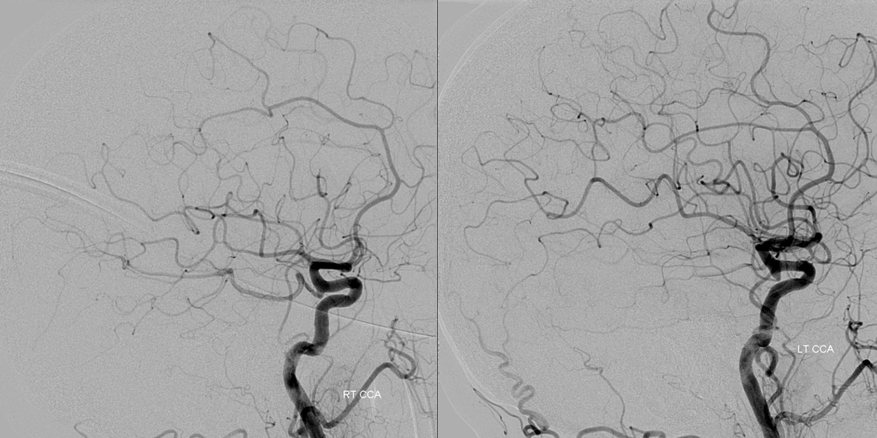 Artery of Percheron Occlusion