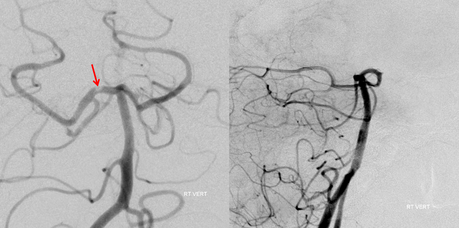 Artery of Percheron Occlusion