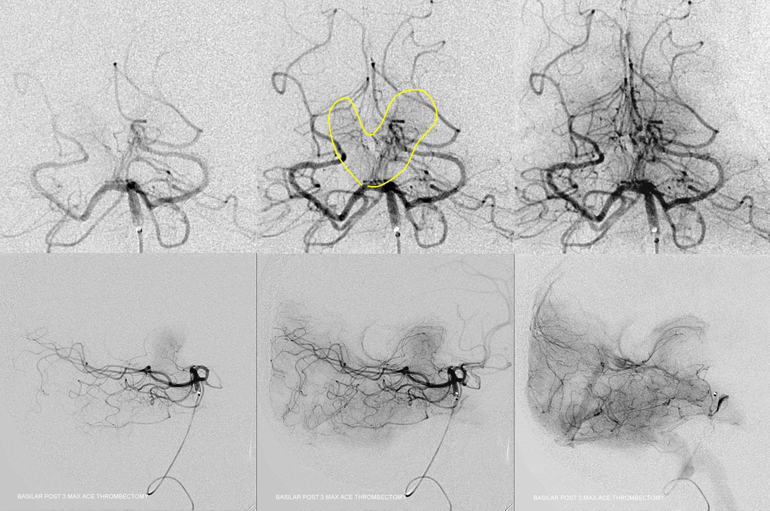 Artery of Percheron Occlusion