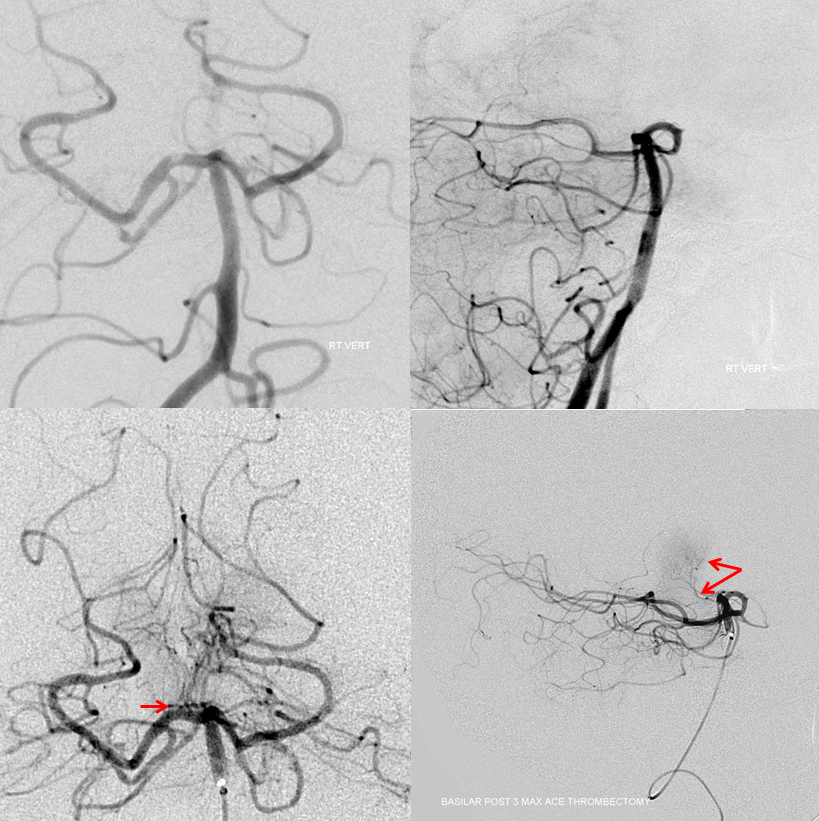 Artery of Percheron Thrombectomy