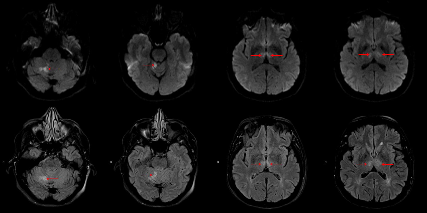 Artery of Percheron Thrombectomy