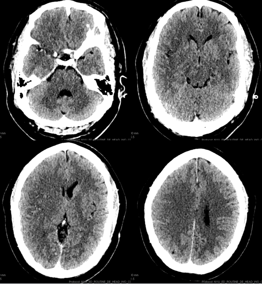 stroke CT CT perfusion