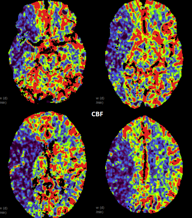 stroke CT CT perfusion