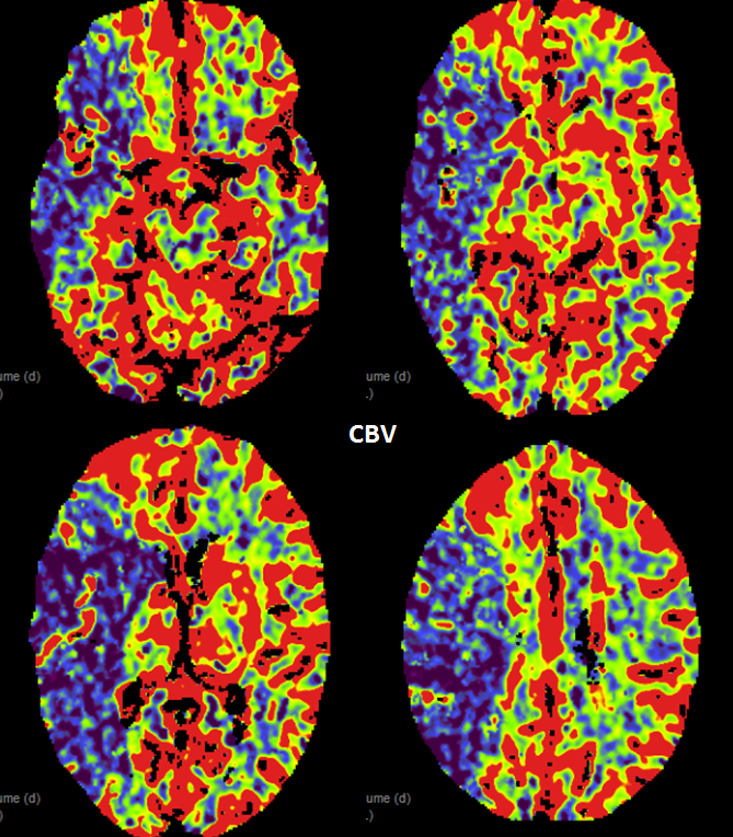 stroke CT CT perfusion