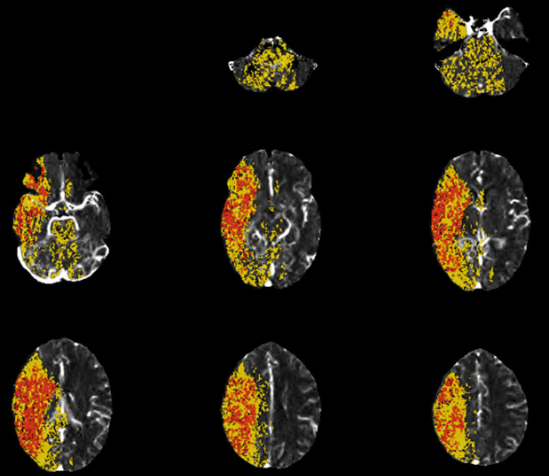 stroke CT CT perfusion