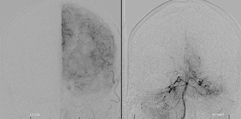 stroke CT CT perfusion