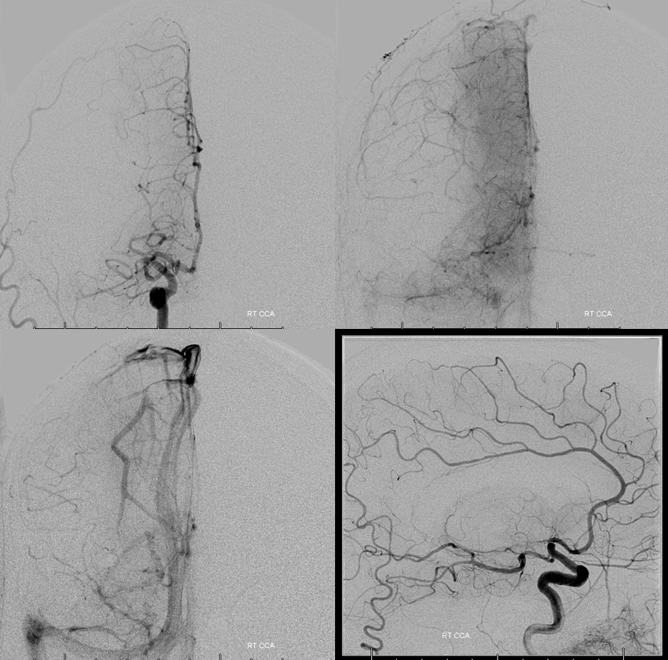 stroke CT CT perfusion