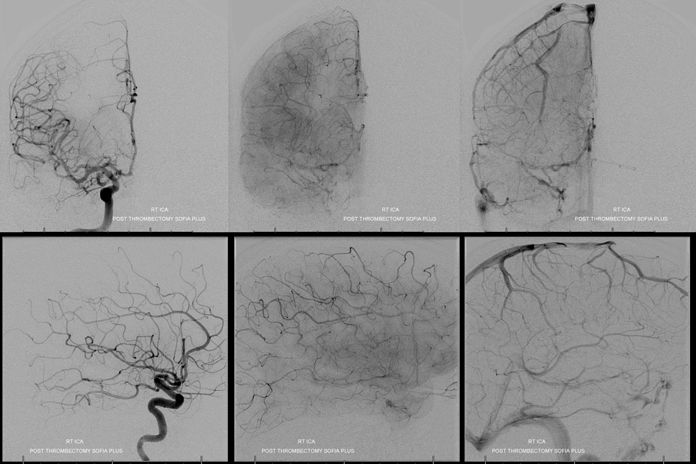 stroke CT CT perfusion