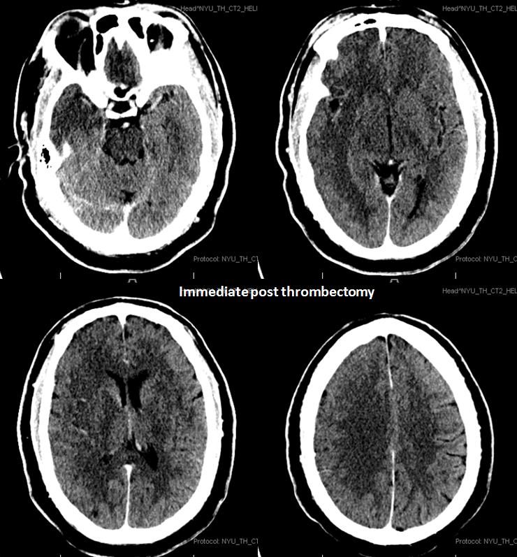 stroke CT CT perfusion