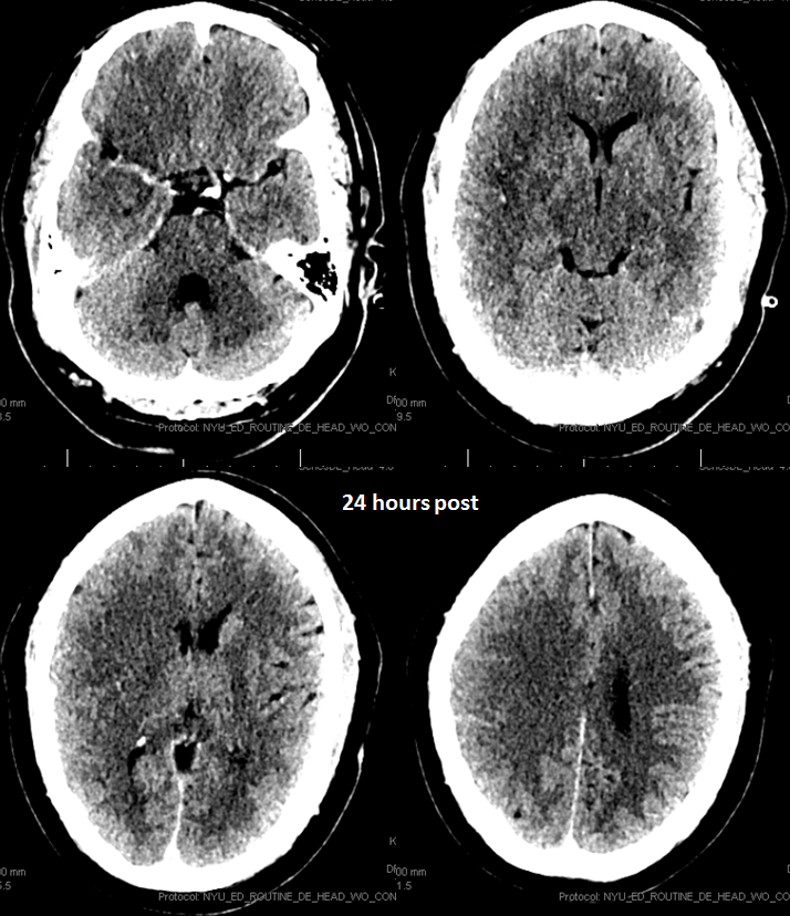 stroke CT CT perfusion