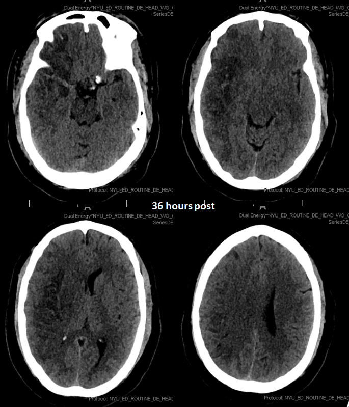 stroke CT CT perfusion