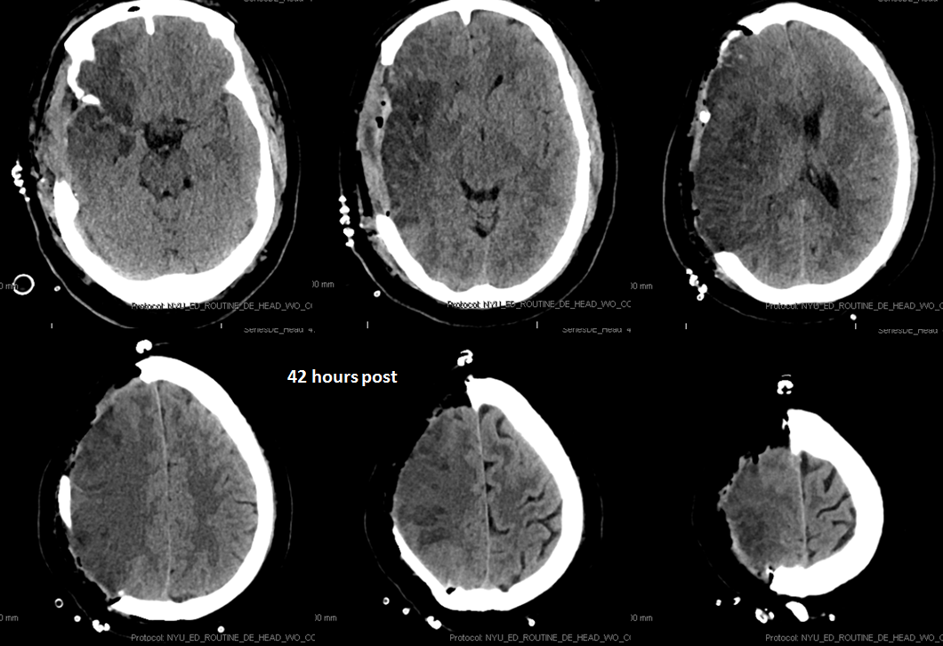 stroke CT CT perfusion