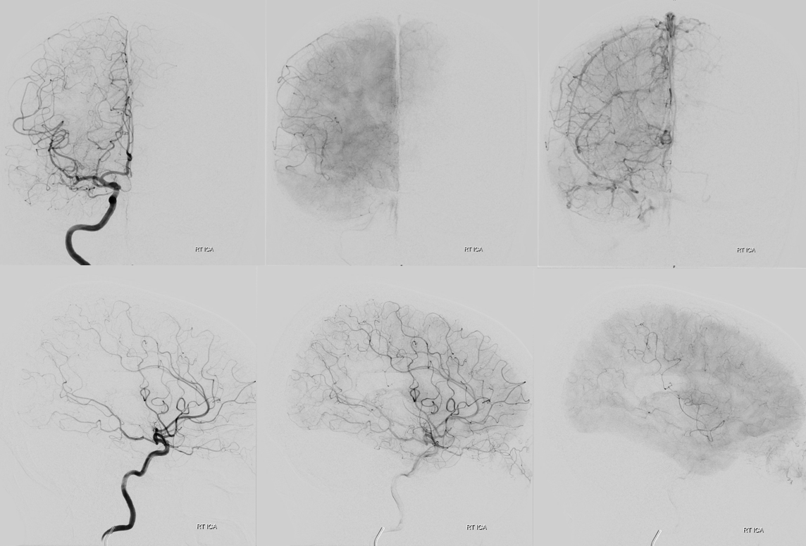 M2 Onyx Resolute Stenting