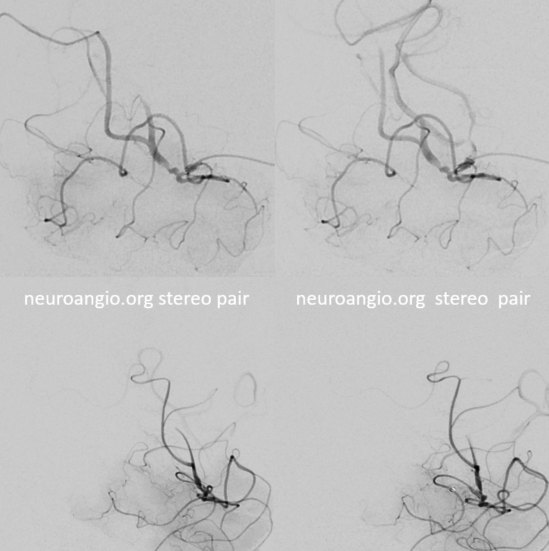 M2 Onyx Resolute Stenting