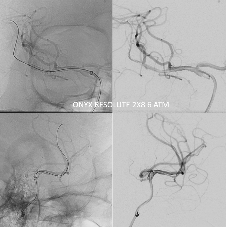 M2 Onyx Resolute Stenting