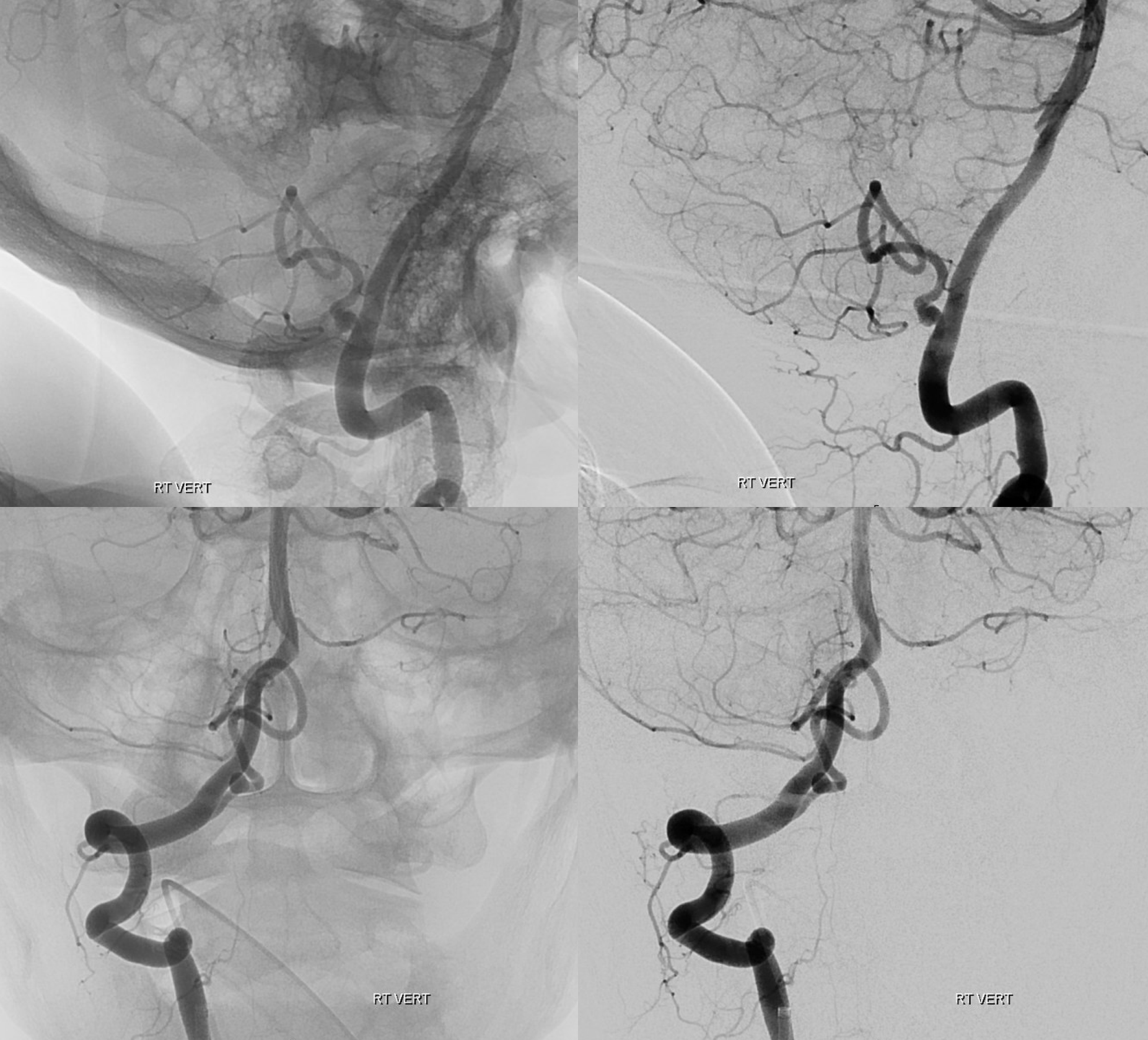 pica aneurysm