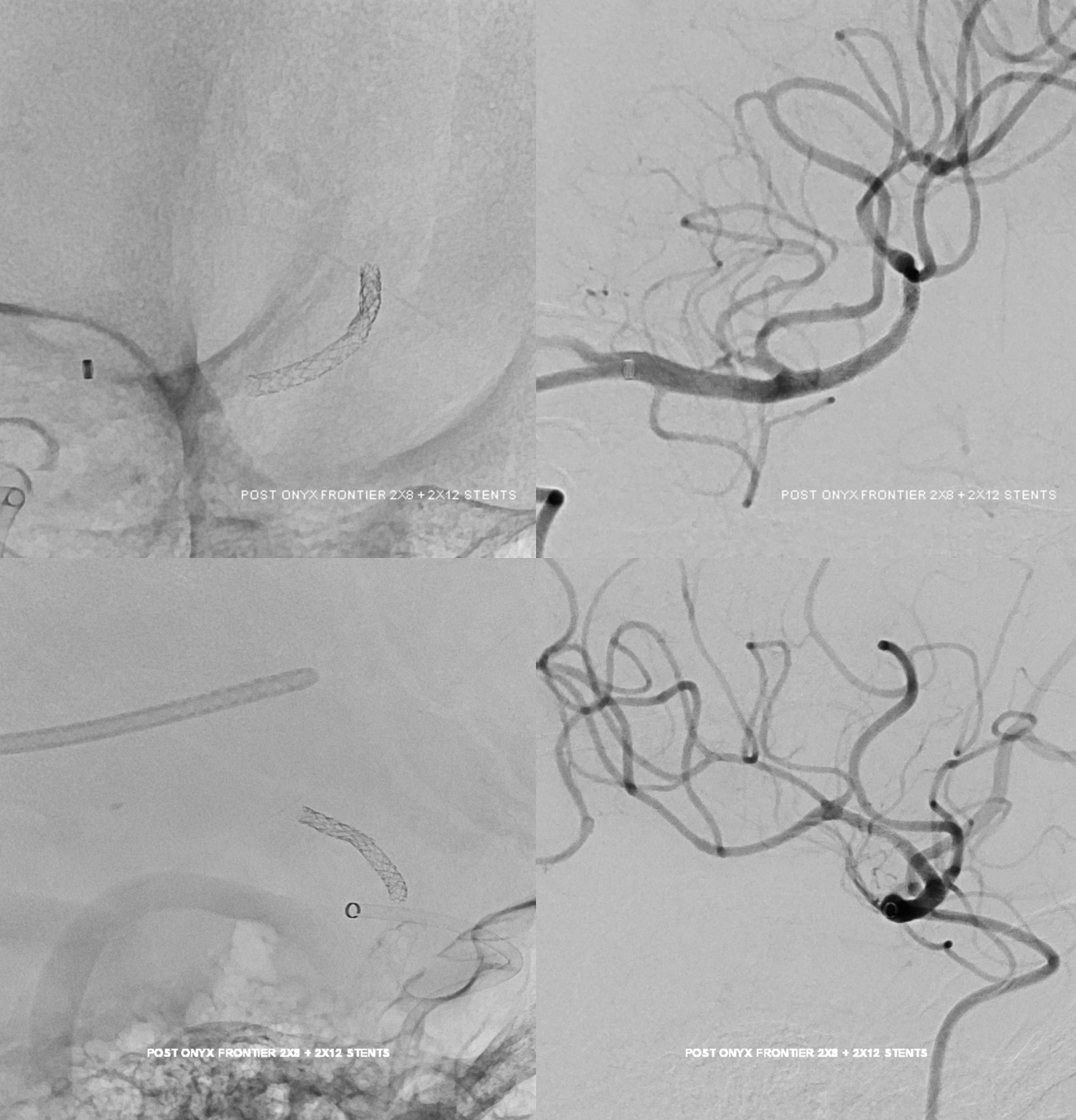 M2 Onyx Resolute Stenting