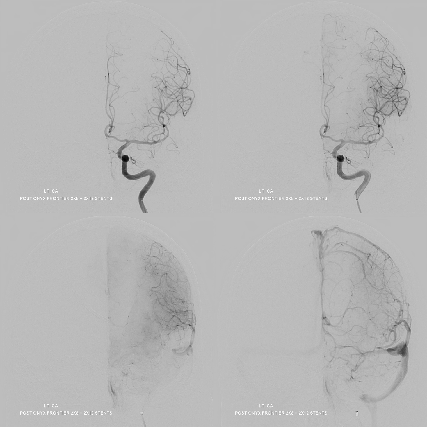 M2 Onyx Resolute Stenting