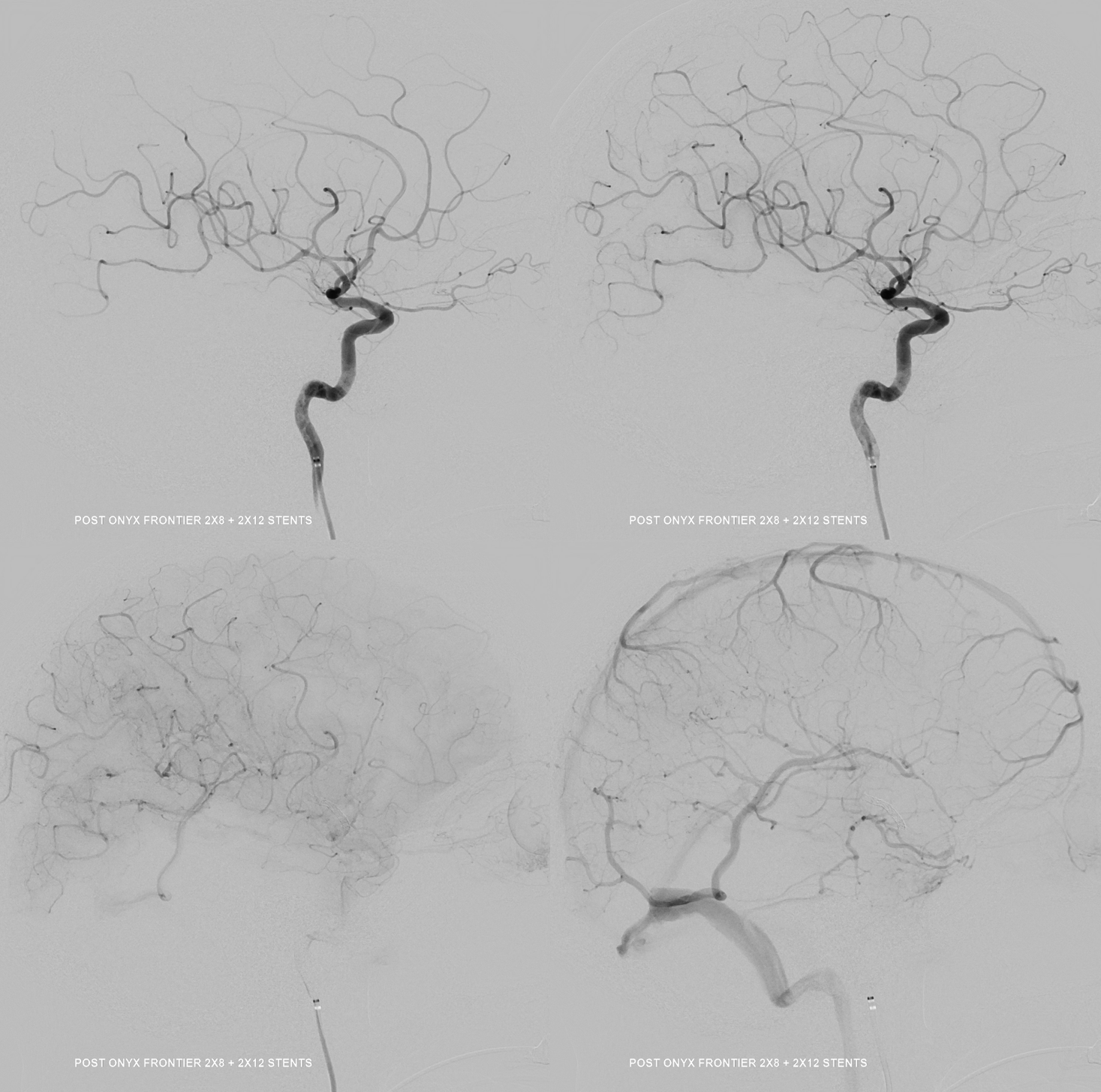 M2 Onyx Resolute Stenting