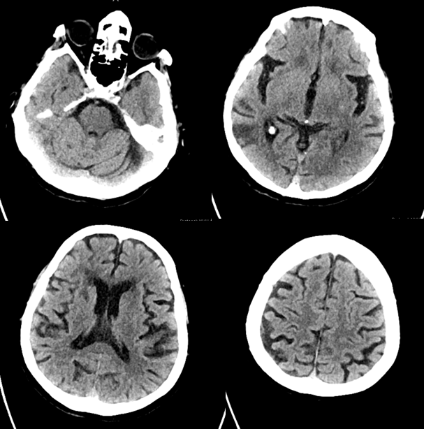 Stroke thrombectomy something for everyone