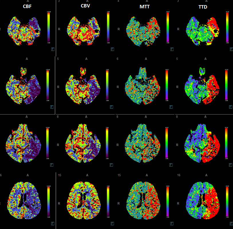 Stroke thrombectomy something for everyone