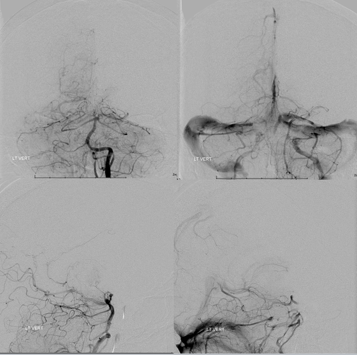 Stroke thrombectomy something for everyone