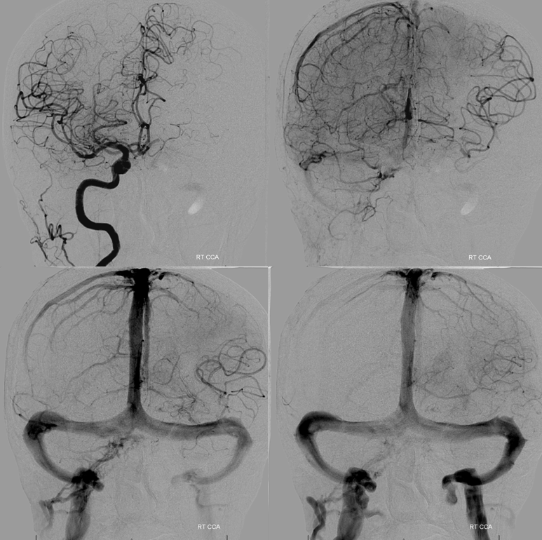 Stroke thrombectomy something for everyone