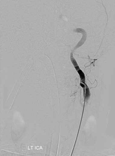 Stroke thrombectomy something for everyone