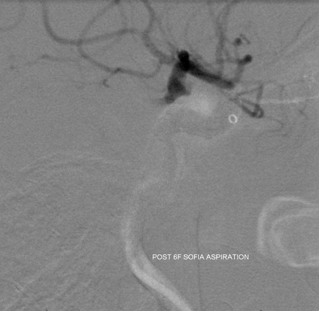 Stroke thrombectomy something for everyone