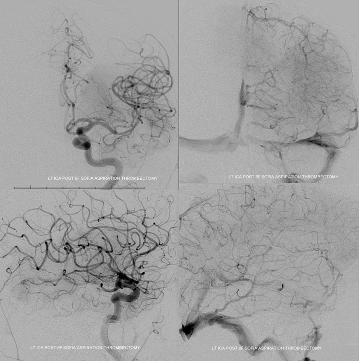 Stroke thrombectomy something for everyone