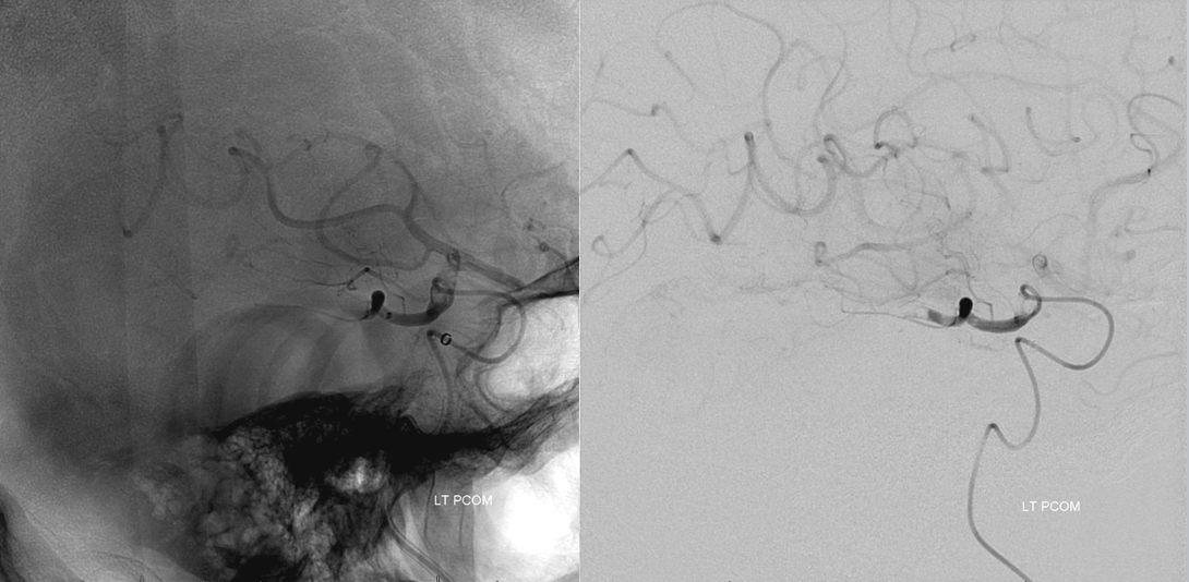 Stroke thrombectomy something for everyone