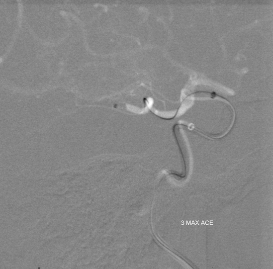 Stroke thrombectomy something for everyone