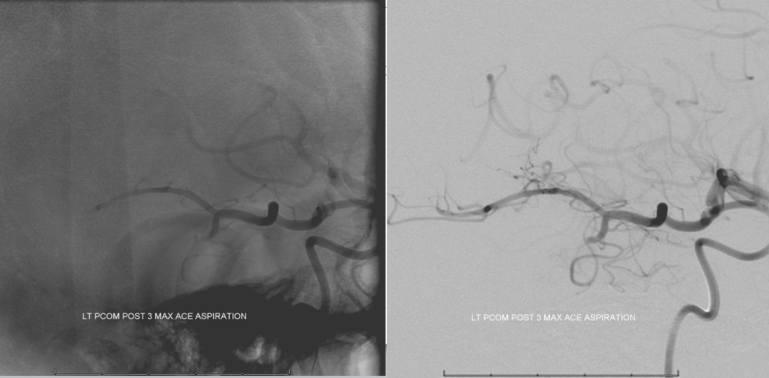 Stroke thrombectomy something for everyone