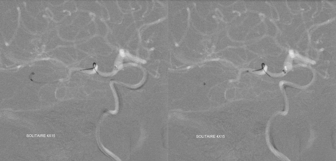 Stroke thrombectomy something for everyone