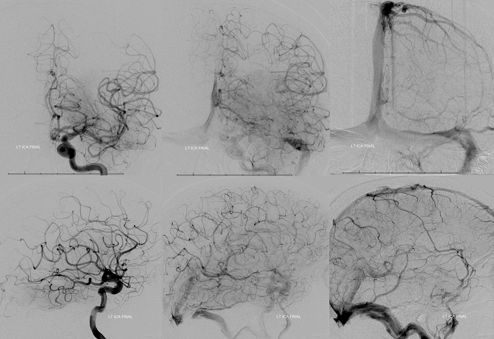 Stroke thrombectomy something for everyone