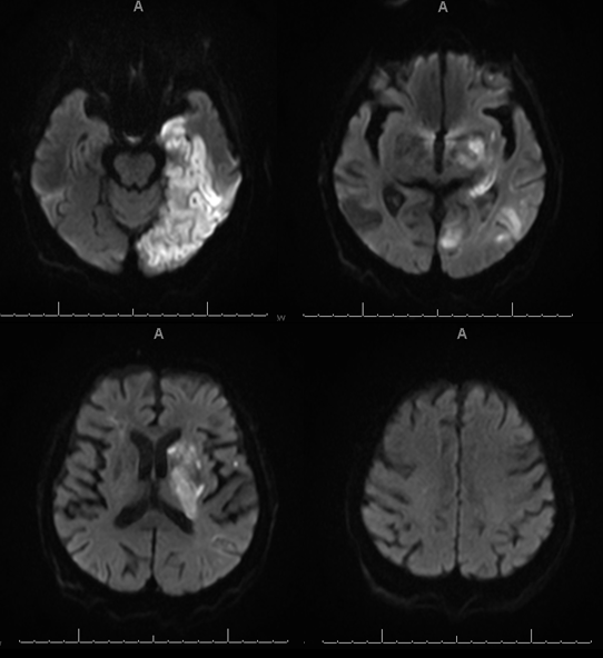 Stroke thrombectomy something for everyone