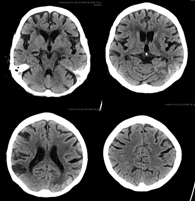 Stroke thrombectomy something for everyone