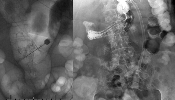 Stroke thrombectomy something for everyone