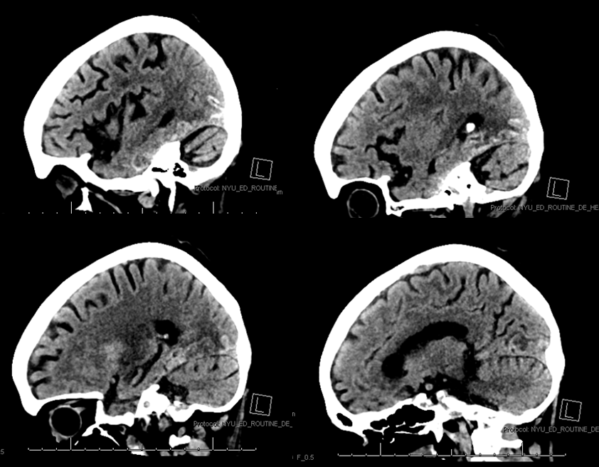 Stroke thrombectomy something for everyone