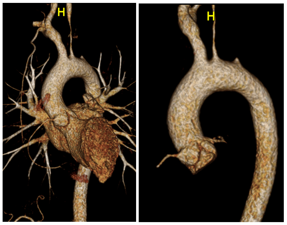 Spinal Vascular Anatomy Neuroangio Org