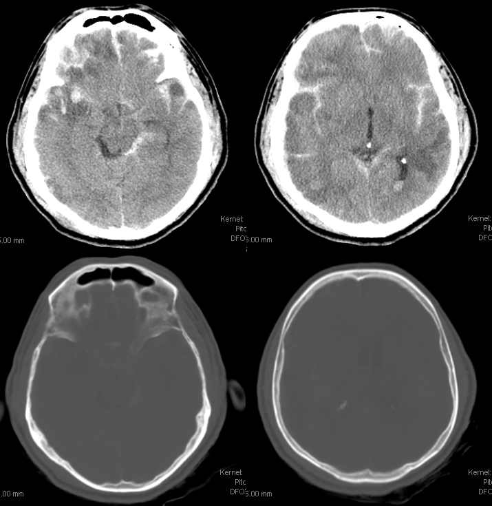 MMA recurrent meningeal fistula