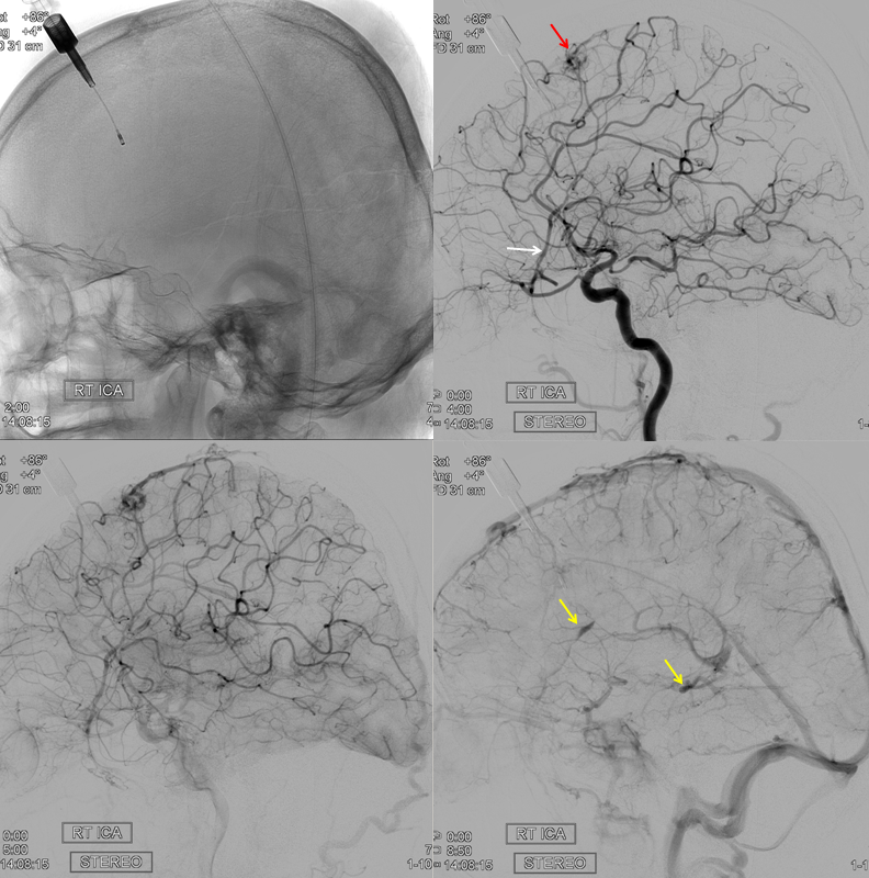 MMA recurrent meningeal fistula