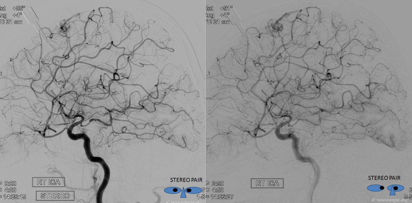 MMA recurrent meningeal fistula