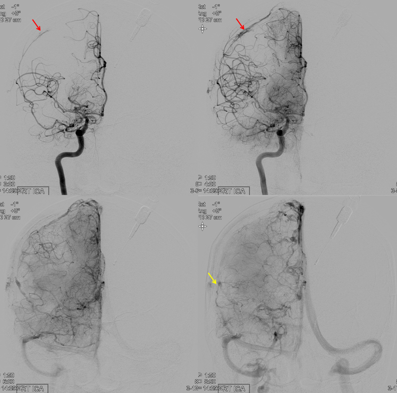 MMA recurrent meningeal fistula